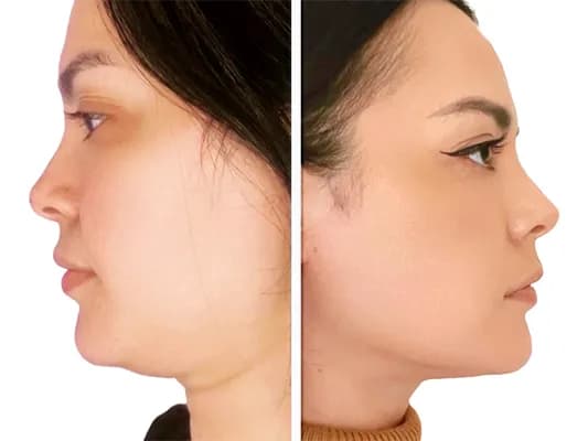 Exo-V-Slim-System-before-and-after-image-1
