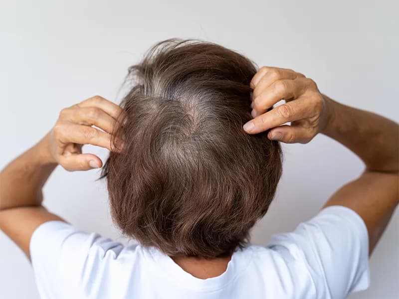 Hair Loss Treatment for Women