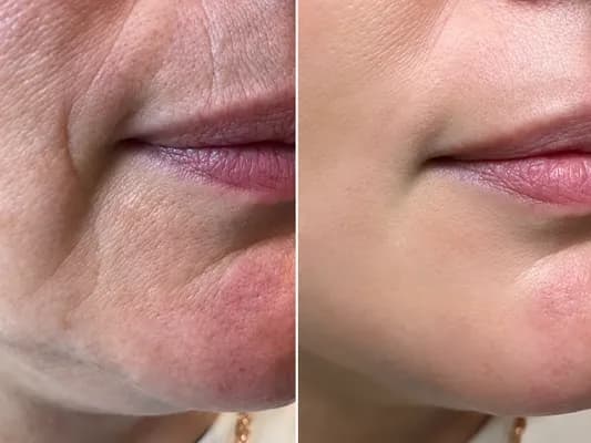 V-Carbon-System-before-and-after-image-3