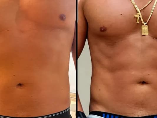 Exo-V-Slim-System-before-and-after-image-3