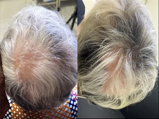 Before and after result - Female, 58, Patchy loss (alopecia areata)