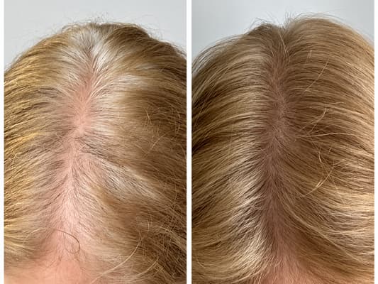 Before and after result - Female, 65, Midline thinning