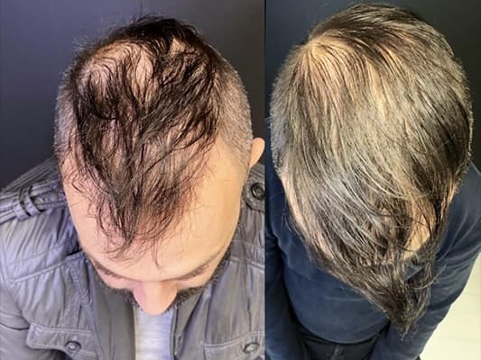Before and after result - Male, 38, Androgenetic alopecia, post-transplant