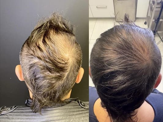 Before and after result - Male, 38, Crown thinning