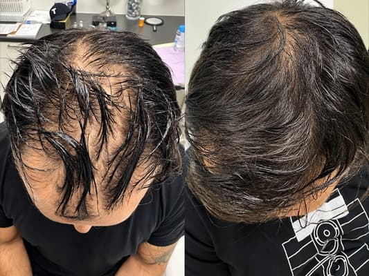 Before and after result - Male, 52, Frontal hairline thinning