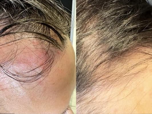 Before and after result - Male, 52, Temple / frontal hairline